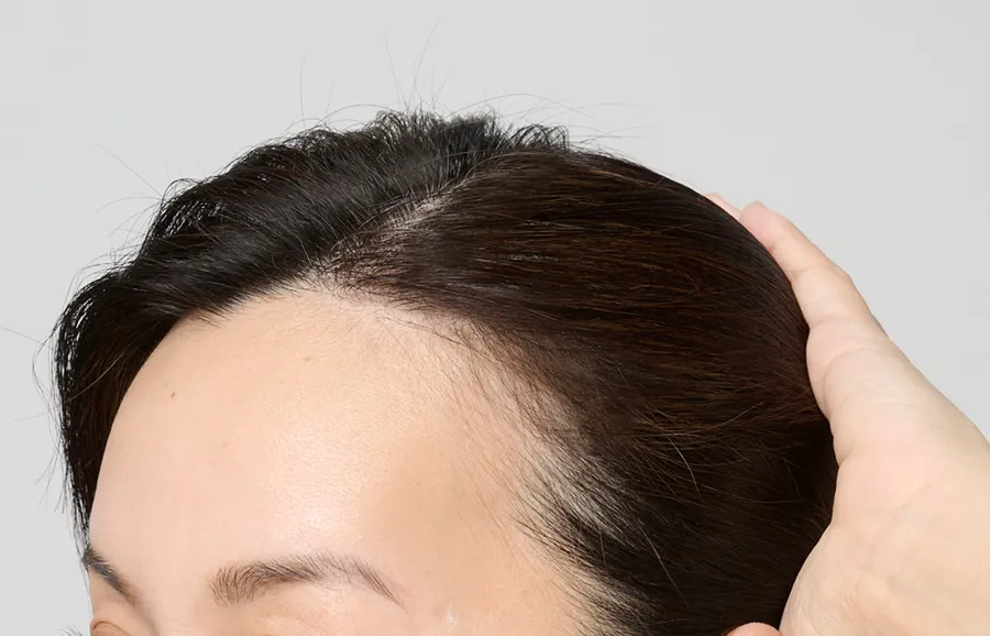 薄毛after